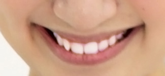 ホワイトニング