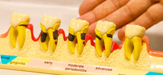 歯周組織再生治療