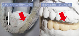 インプラント治療